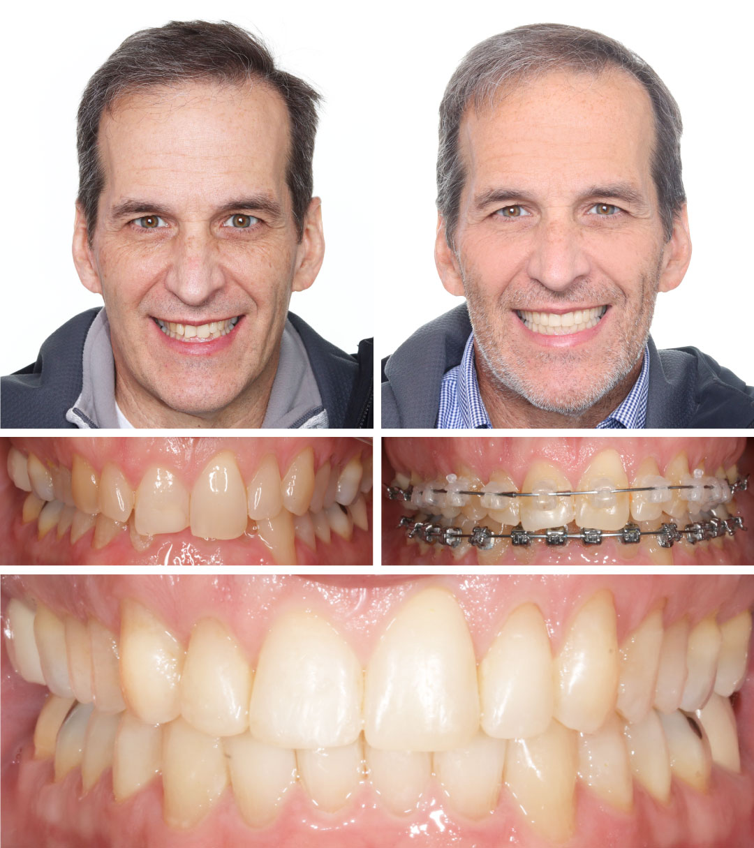 Orthodontics in Kansas City ,Gladstone Orthodontist ,Parkville , Liberty ,Platte City Orthodontist - KC Braces + Kids